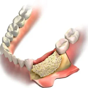 بازسازی راموس